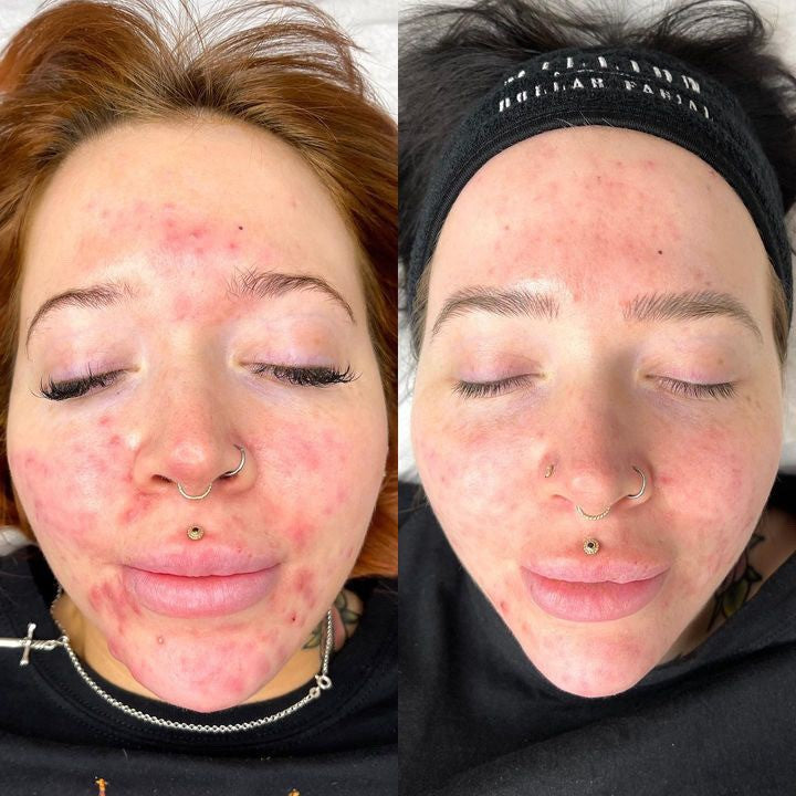 Blemish Prone Skin