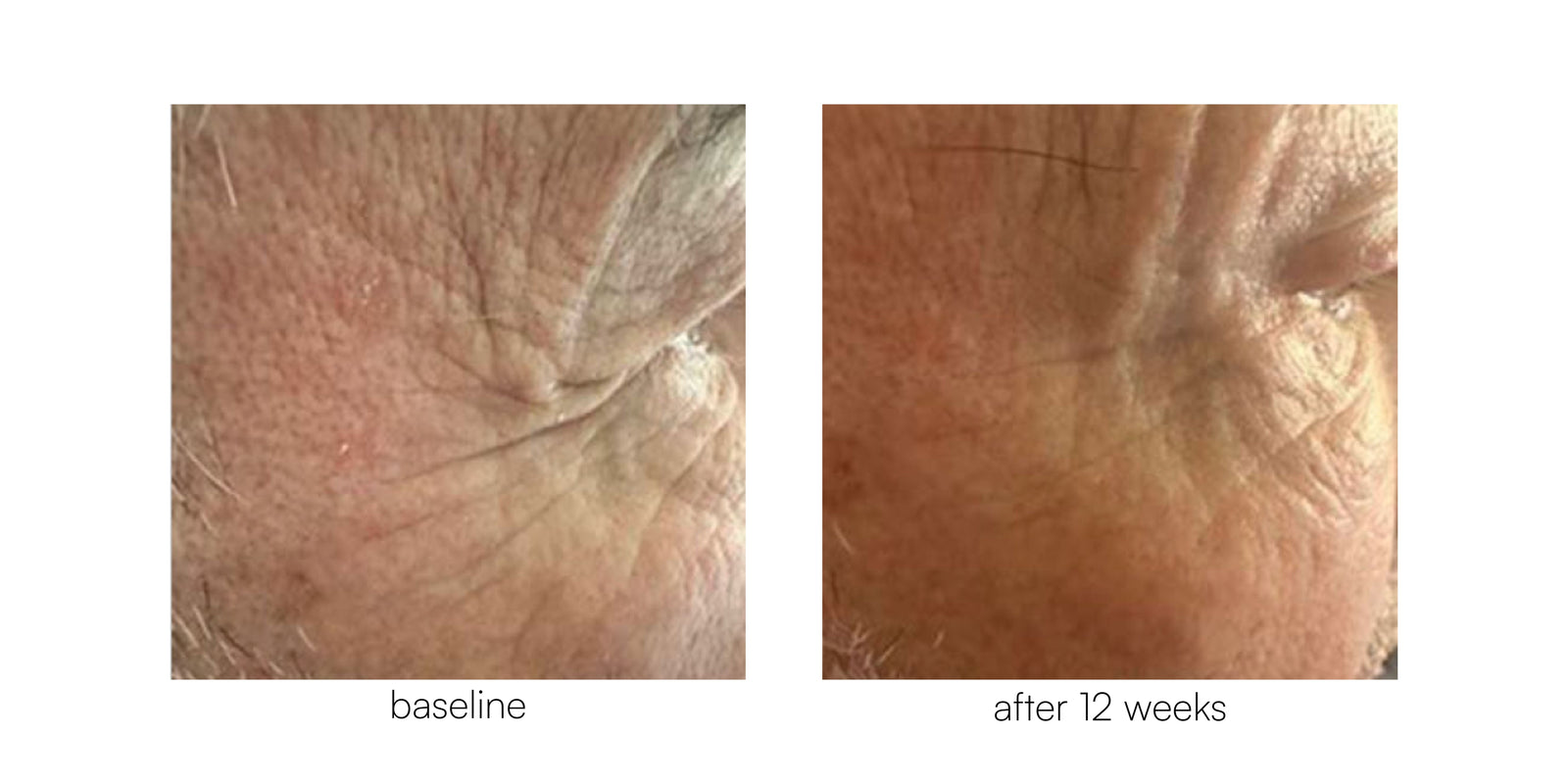 Fine Lines & Wrinkles - baseline vs after 12 weeks (Morley Clinic)