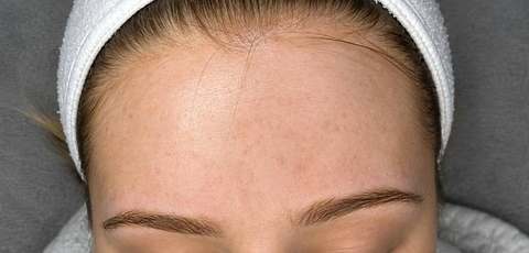 Forehead skin after PRO treatment — redness visibly diminished