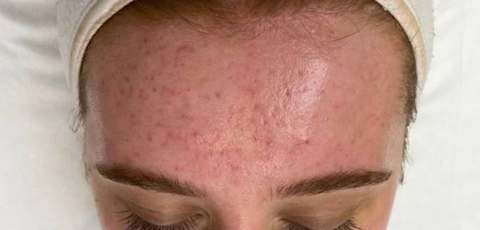 Forehead skin before PRO treatment — visible redness