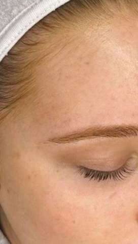 Skin after PRO treatment — redness visibly reduced