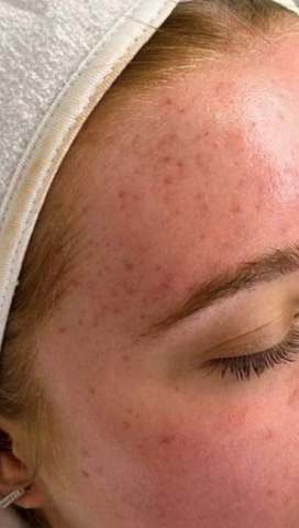 Skin before PRO treatment — visible redness and uneven tone