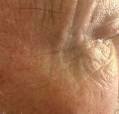 Close-up skin texture after PRO treatment — visibly smoother, fine lines reduced