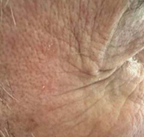 Close-up skin texture before PRO treatment — visible fine lines