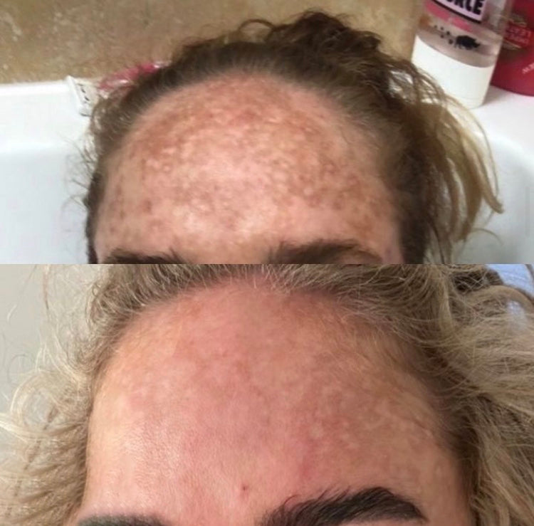 Pigmentation