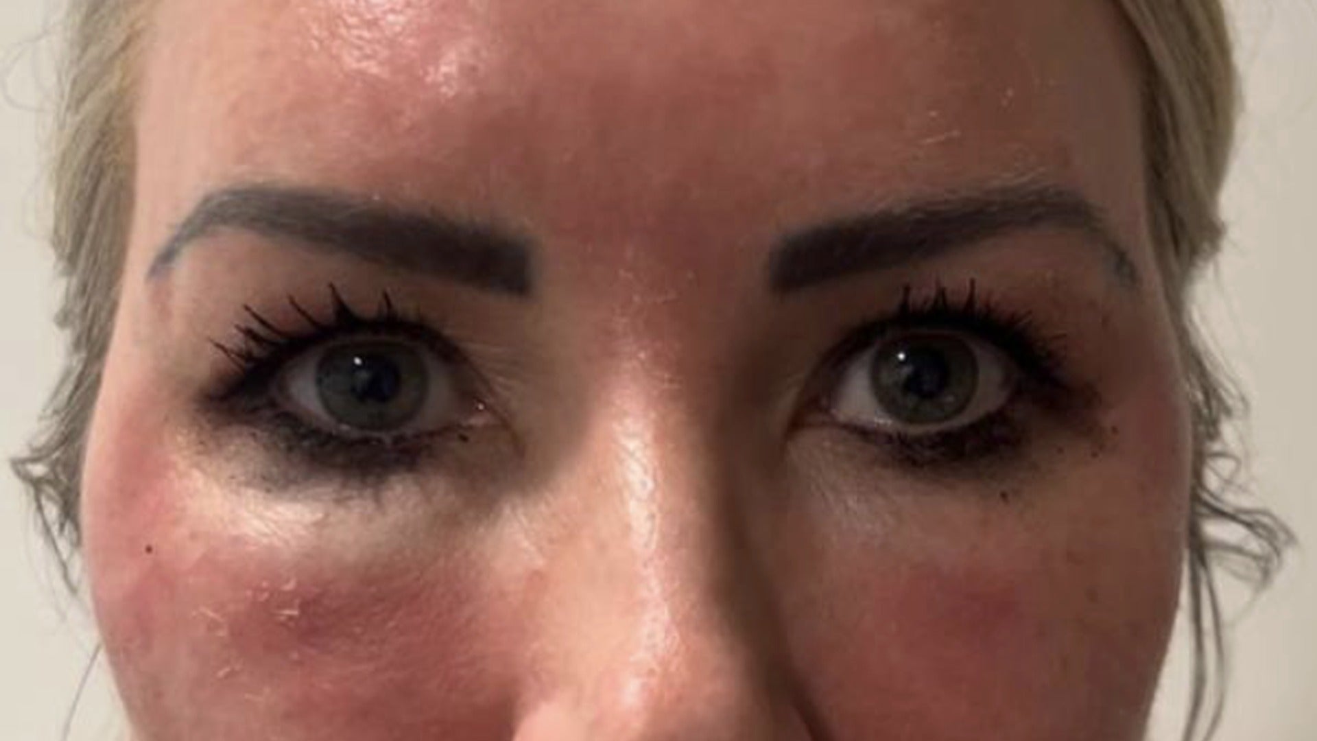 Skin appearance before use of Sculpta